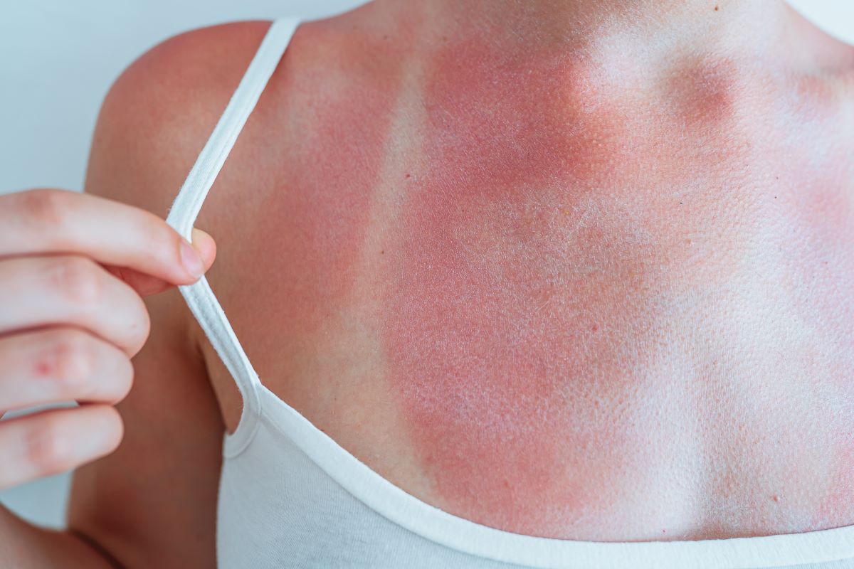 Sonnenbrand in Warendorf vermeiden und richtig behandeln – E